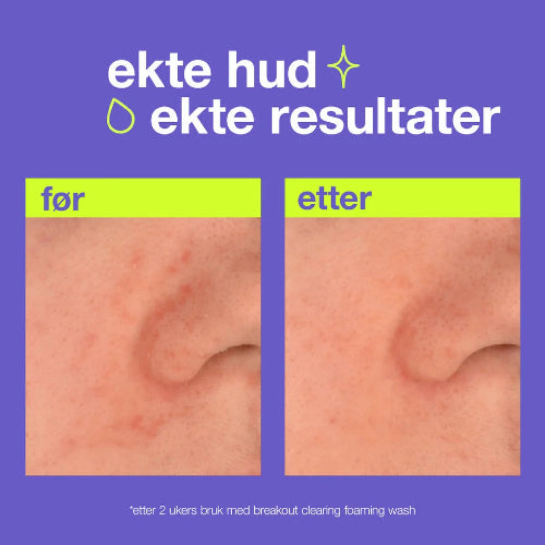 Ekte hud, ekte resultater: Dermalogica Clear Start Breakout Clearing Foaming Wash gir synlig forbedring av kviser etter 2 ukers daglig bruk – klinisk dokumentert